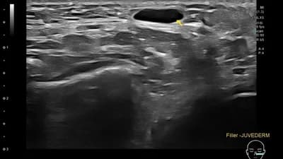 ภาพ Ultrasound แสดงสารเติมเต็มเดิมในชั้นเนื้อเยื่อใต้ผิว