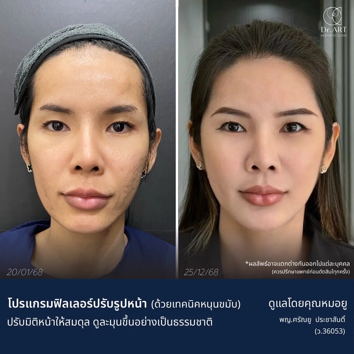 โปรแกรมฟิลเลอร์ปรับรูปหน้า ด้วยเทคนิคหนุนขมับ — ภาพก่อนและหลังรับบริการ