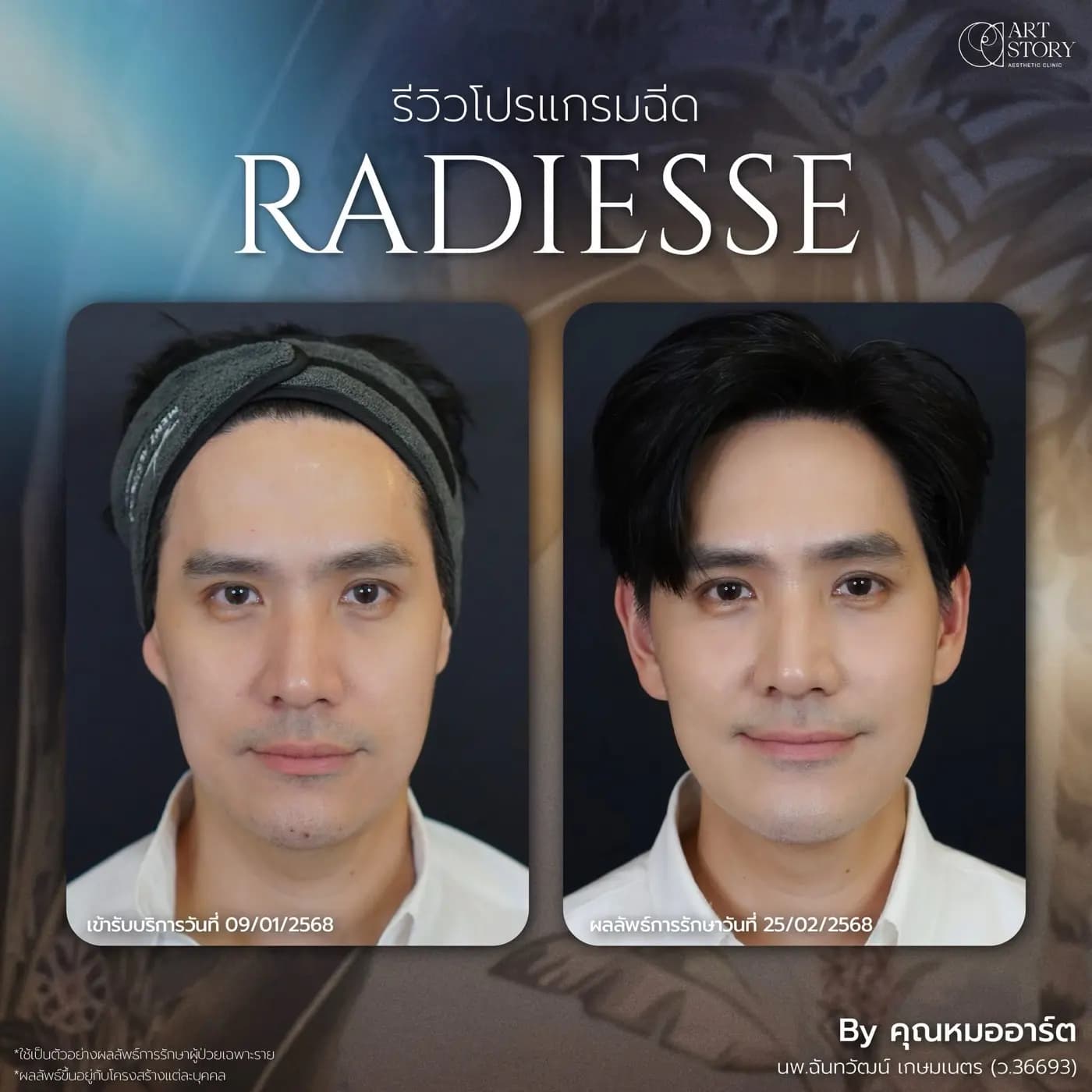 โปรแกรมฟื้นฟูคุณภาพผิว ด้วย Radiesse® — ภาพก่อนและหลังรับบริการ