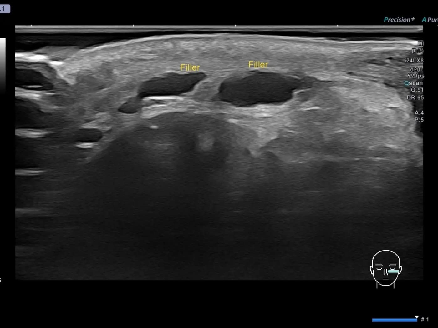 ภาพ Ultrasound แสดงตำแหน่งและชั้นของฟิลเลอร์เดิมใต้ผิว ก่อนวางแผนการสลาย